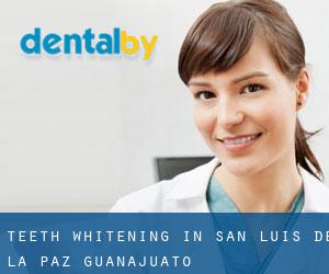 Teeth whitening in San Luis de la Paz (Guanajuato)